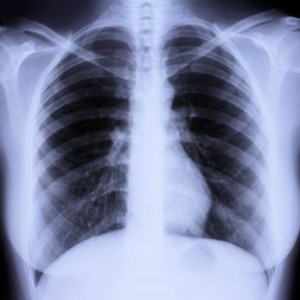 10-26-11-chest-x-ray-istock_000008877460xsmall1